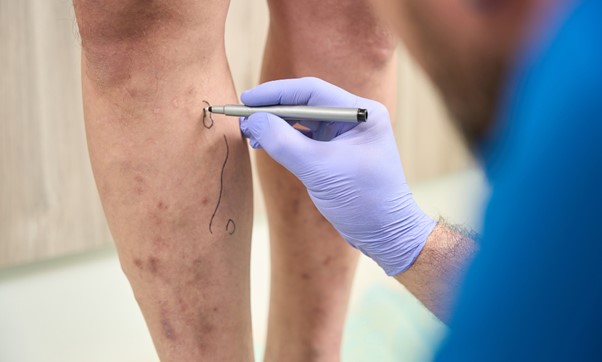 A Comprehensive Guide to the Procedure and Recovery of Sclerotherapy