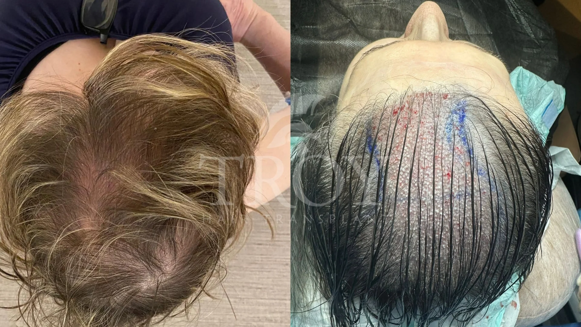 After Treatment Care for a Hair Transplant