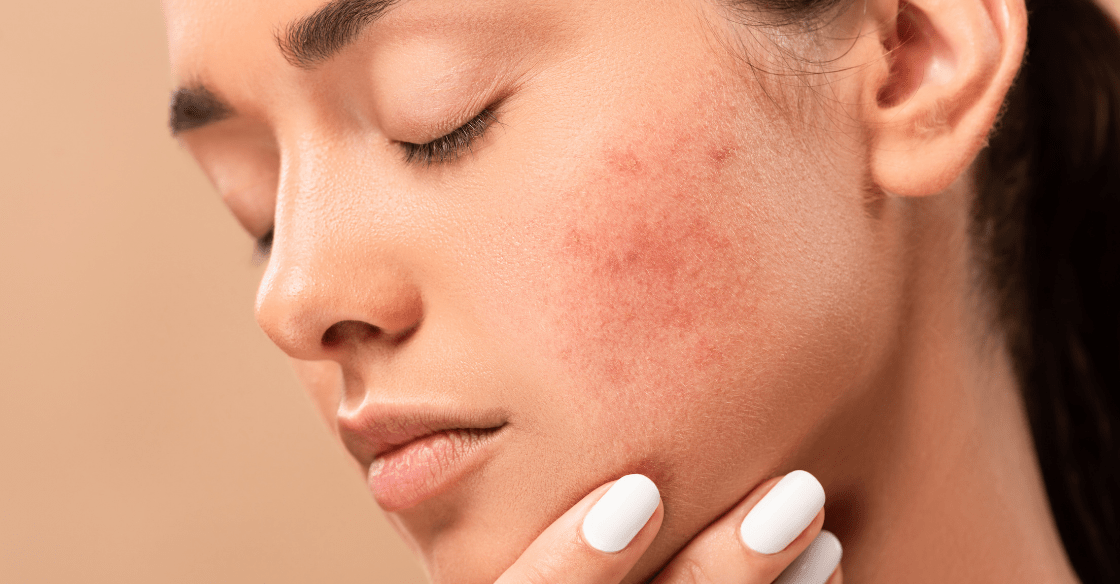 Understanding the Different Types of Acne and Their Treatments