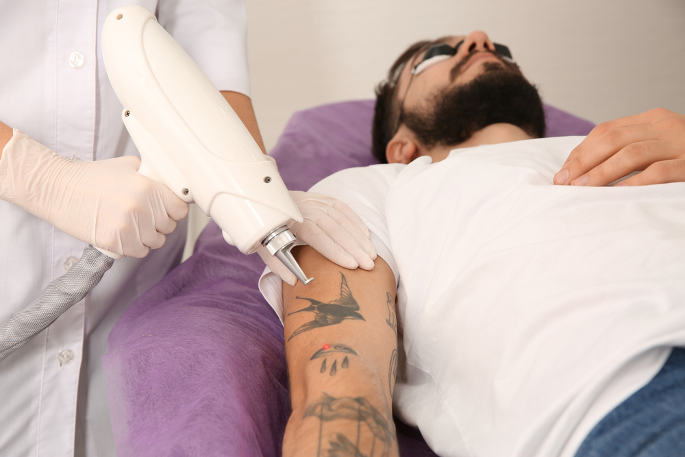 3 Types of Lasers Used to Remove Tattoos